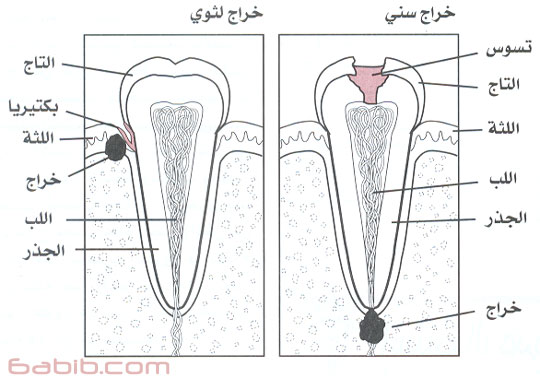   Tooth abscess ,    