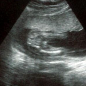 شكل الجنين فى الشهر الأول  , الحمل في الشهر 1