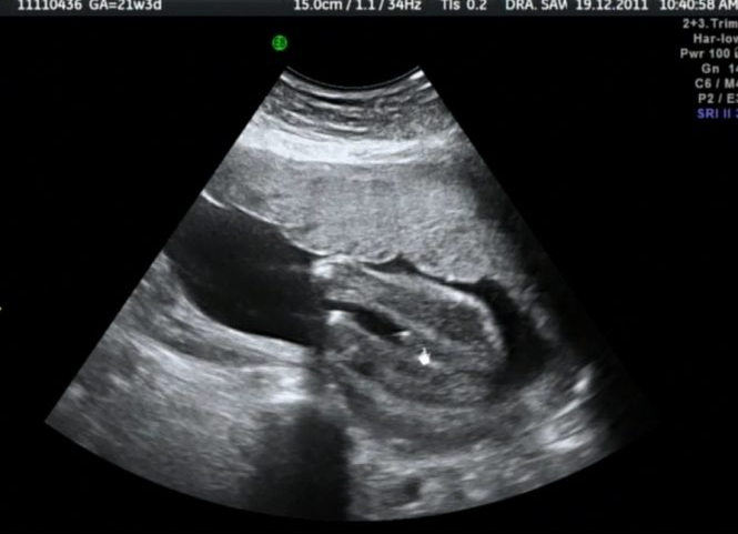 حجم الجنين في الشهر 2 , شكل الجنين فى الشهر الثاني